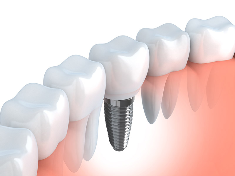 implants implants